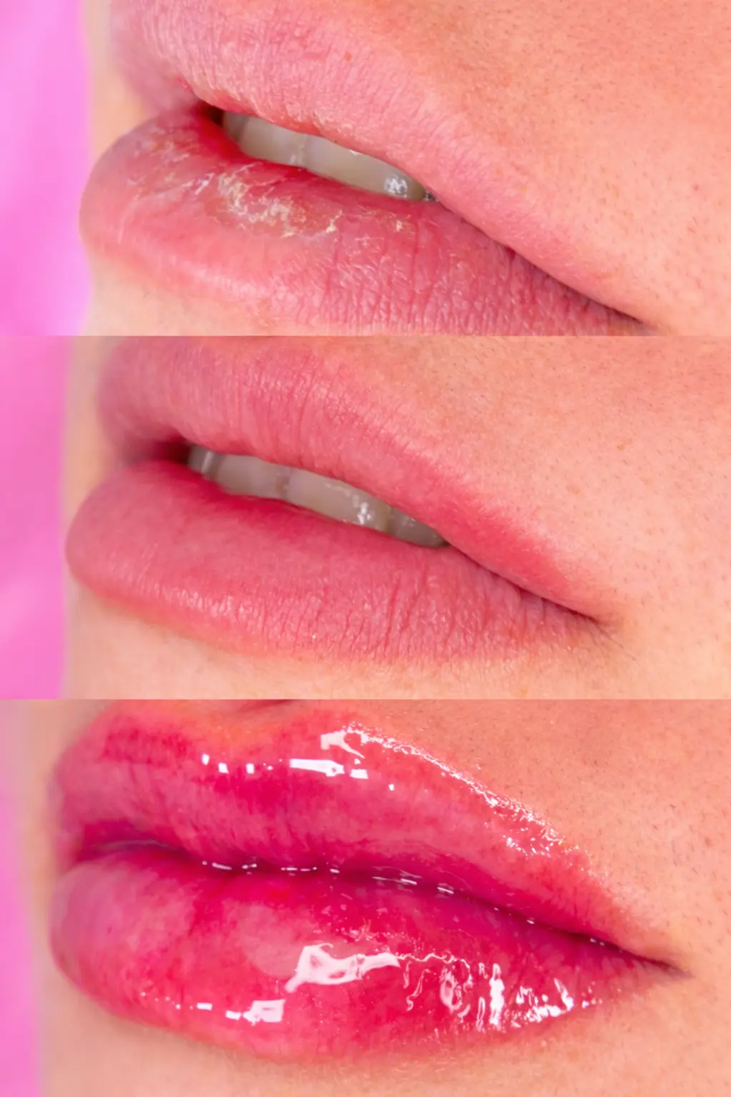 Hidragloss en Vélez-Málaga, spa de labios con hidratación profunda, volumen natural y efecto rejuvenecedor sin rellenos